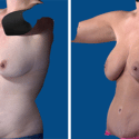 Breast-Augmentation Tummy-Tuck Portland OR
